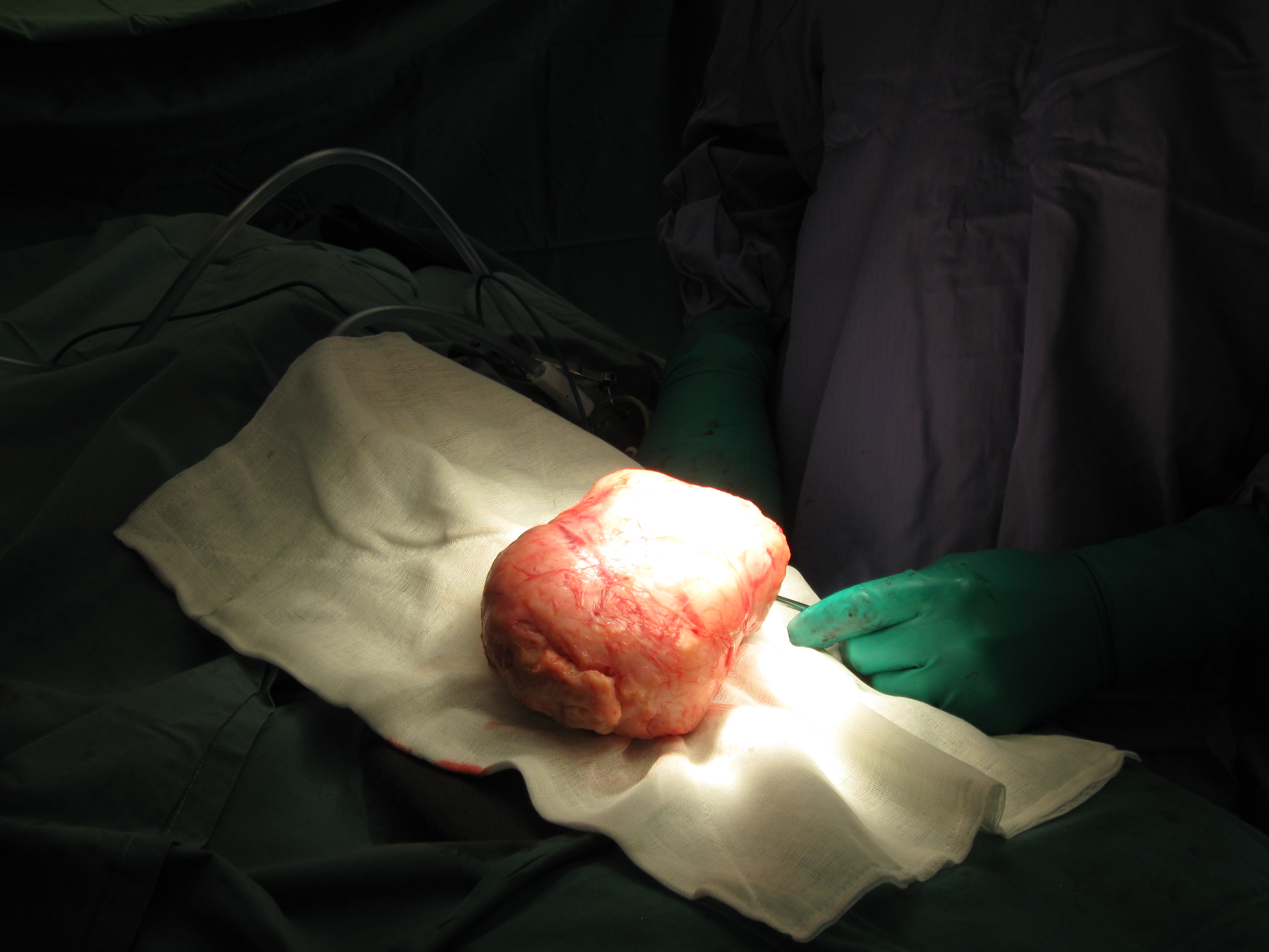 Fibroid Abdominal Myomectomy Serag Youssif (11)